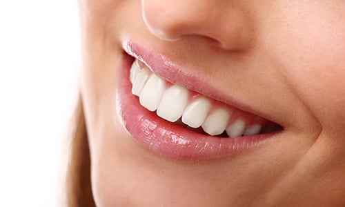 Какво-представляват-зъбните-фасети?