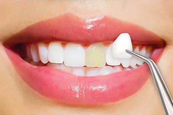 Types-of-Dental-Veneers