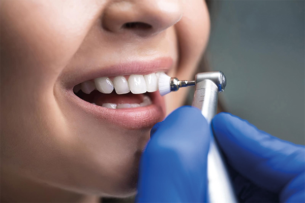 Wie oft sollte eine Zahnreinigung durchgeführt werden