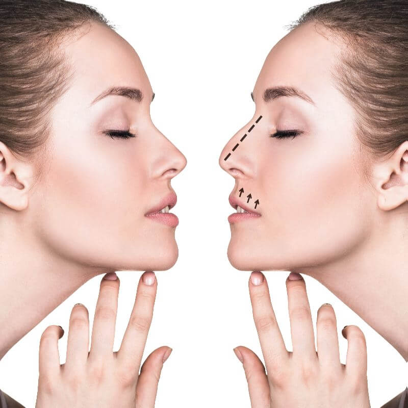 Comment nettoyer son nez après une rhinoplastie ? Nez bouché et nettoyage