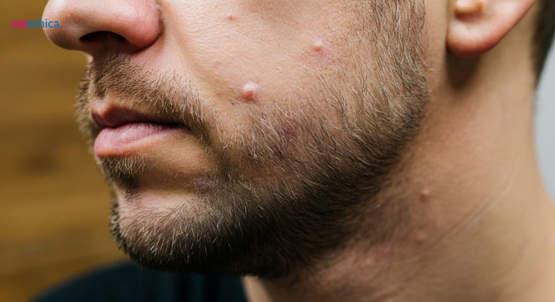 Пошаговое руководство по пересадке бороды