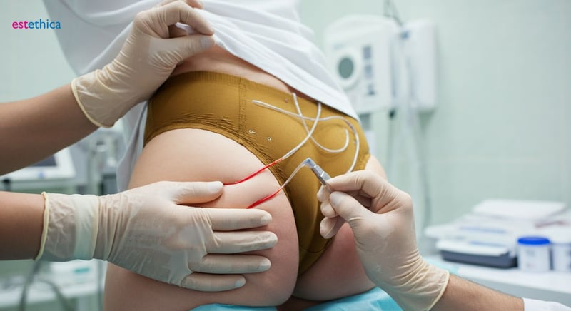 Подготовка к липофилингу ягодиц: советы специалистов