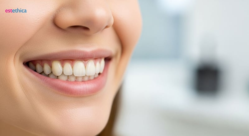 ابتسامة هوليود المميزة