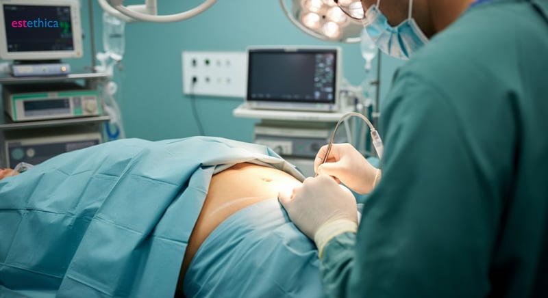 Abdominal etching procedure illustration
