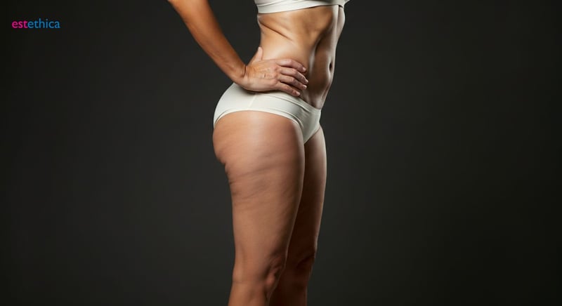 Comparación entre abdominoplastia y lipectomía