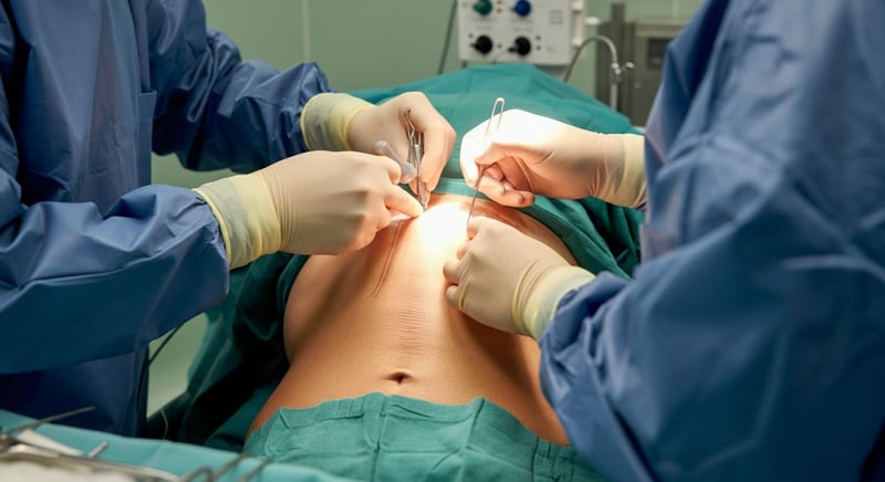 Abdominoplastie pentru abdomen plat și tonifiat