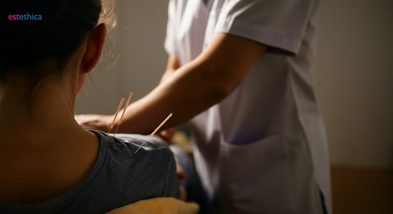 Acupunctura pentru dureri de spate, soluție naturală eficientă
