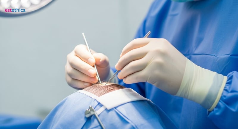 Alopecia Androgenética: Injerto Capilar como solución