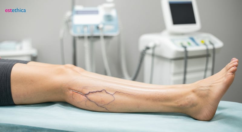 Arañas vasculares en piernas, soluciones cosméticas
