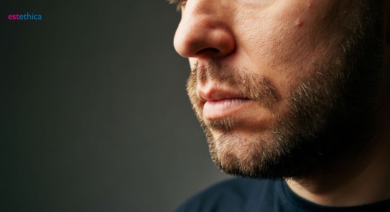 ¿Barba Rala? Mejora tu estética facial