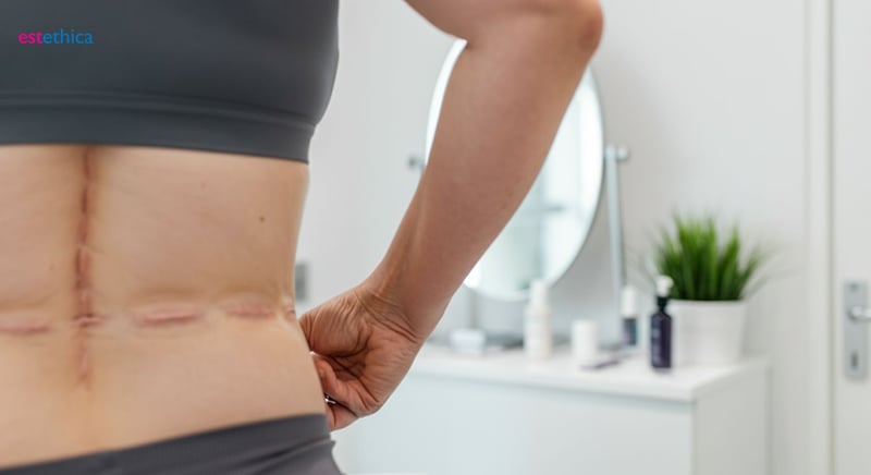 Bauchdeckenstraffung ohne Muskelstraffung: Geeignet für bestimmte Patienten