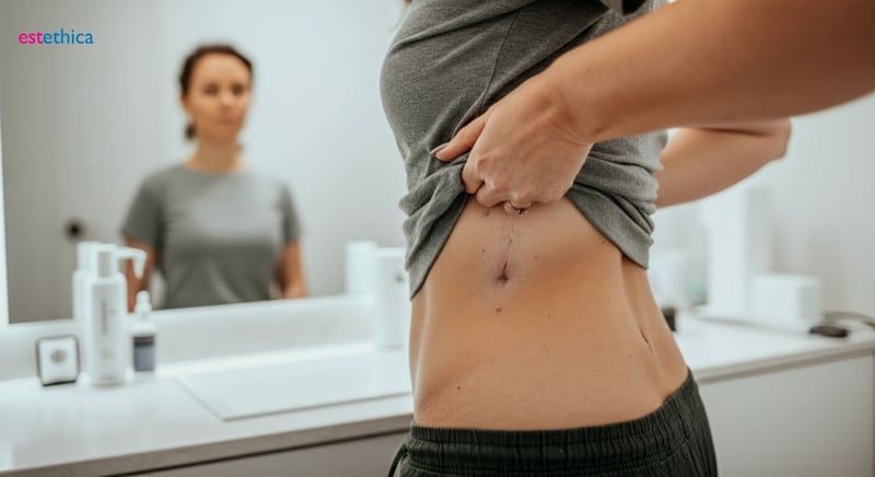 Bauchstraffung ohne Muskelstraffung möglich