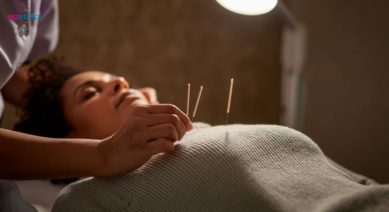 Beneficios de la acupuntura para una vida saludable