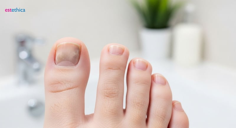 Diagnóstico de hongos en las uñas