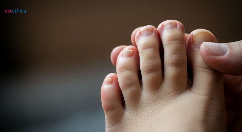 Causas del hongo en las uñas y prevención