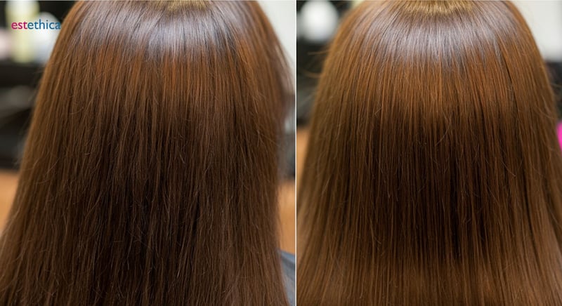 Choosing the Right Clinic for Hair Transplant