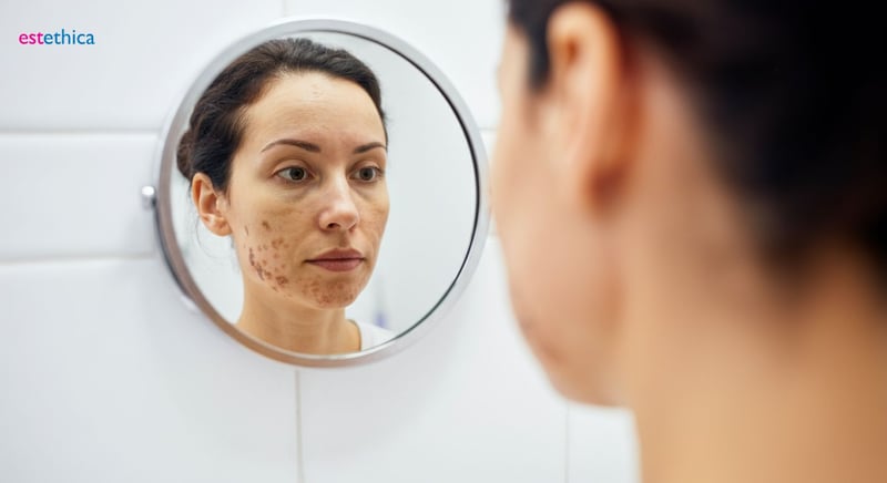 Cremas para manchas: ingredientes clave y elección ideal