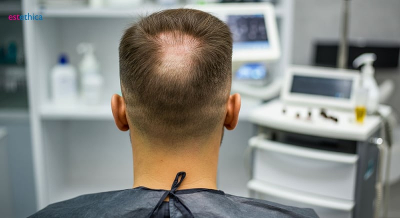 نتائج زراعة الشعر: هل هي دائمة؟