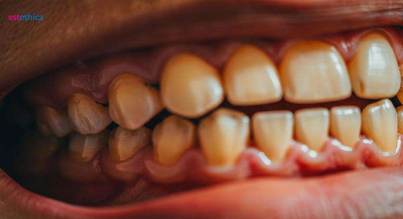 Plombe dentare: importanță și beneficii