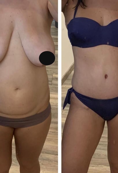 Ich fühle mich nach drei Kindern endlich wieder wie ich selbst. Das Mommy Makeover hat all meine Bedenken auf einmal angesprochen, und die Ergebnisse übertreffen meine Erwartungen. Ich habe mein Selbstbewusstsein aus der Zeit vor der Schwangerschaft zurückgewonnen!