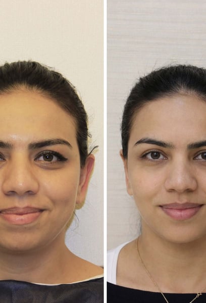 Ich bevorzuge es, meine Haare kurz zu halten, aber meine auffälligen Ohren haben mich immer unsicher gemacht. Diese Operation hat das komplett behoben. Jetzt fühle ich mich beim Friseur und beim Blick in den Spiegel viel wohler. Wirklich professionelle Arbeit.