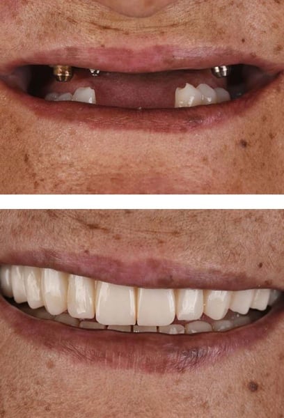 Estaba dudoso sobre ponerme un implante, pero el resultado es increíble. Se ve y se siente exactamente como mis dientes naturales. ¡Finalmente puedo comer y sonreír con total confianza de nuevo!
