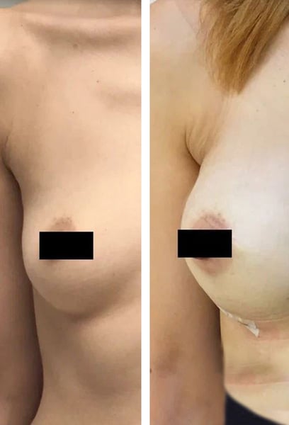 Ich war besorgt über die Genesung, aber die minimal-invasive Technik, die sie verwendet haben, hat Wunder gewirkt. Ich war viel schneller als erwartet wieder in meiner täglichen Routine!