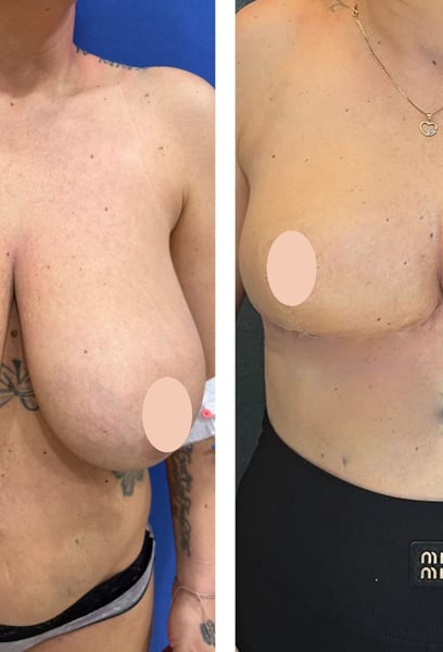 Rezultatele estetice au depășit așteptările mele. Forma este naturală și frumoasă, iar tehnica de cicatrizare minimă pe care au folosit-o este cu adevărat impresionantă. Recuperarea mea a fost mult mai ușoară decât mi-am imaginat.