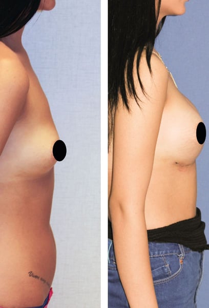 لقد وجدت أخيرًا المكان المناسب لزيادة حجم ثديي في إسطنبول. النتائج تبدو وتشعر بأنها طبيعية بشكل مذهل، تمامًا كما كنت آمل!