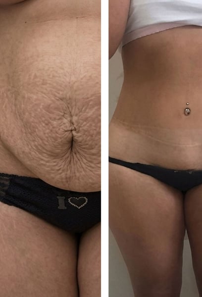 Dès la première consultation, tout était transparent. Mon chirurgien a parfaitement géré le processus de plastie abdominale, les étapes de récupération et mes attentes. La douleur était bien moins intense que je ne l'avais anticipé.