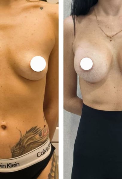 Après avoir fait des recherches partout, je les ai choisis pour ma chirurgie. C'était la meilleure décision que j'ai jamais prise pour ma confiance en moi et mon image corporelle.