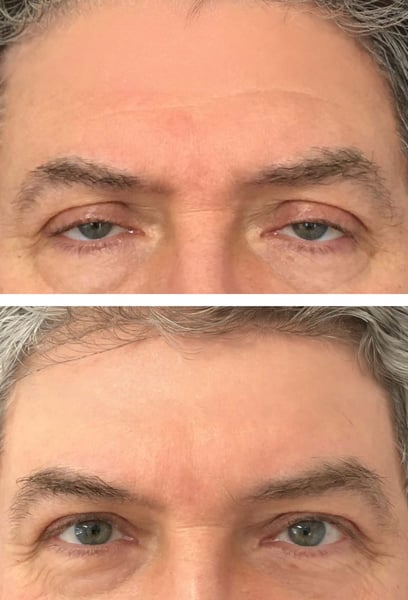 J'ai passé des années à réfléchir à cette chirurgie, et mon seul regret est d'avoir attendu si longtemps. La sensation de 'lourdeur' dans mes yeux a disparu, et la peau est beaucoup plus lisse. C'est incroyable de voir comment une procédure si délicate peut transformer tout votre visage, le faisant passer d'un air triste à vibrant. Tout simplement parfait !