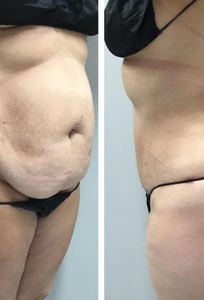 Ich war als Mann unsicher bezüglich einer Bauchoperation, aber die Ergebnisse sprechen für sich. Der Chirurg hat die hartnäckige Haut entfernt und meine Bauchmuskeln gestrafft, was mir ein viel maskulineres und fitteres Profil gegeben hat. Die Genesung verlief reibungslos, und die Narbe ist sehr gut versteckt. Wenn du als Mann darüber nachdenkst, zögere nicht – diese Klinik ist die beste.