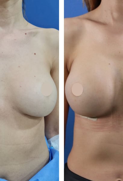 Das Team war sehr professionell. Sie haben mir geholfen, die perfekte Implantatgröße und -form auszuwählen, die perfekt zu meinen Körperproportionen passt.