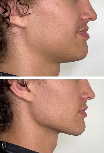 Diese Operation hat nicht nur meinen Kiefer korrigiert; sie hat mein ganzes Gesicht ins Gleichgewicht gebracht. Die Symmetrie ist perfekt, und ich habe das Gefühl, meine männlichen Züge zurückgewonnen zu haben. Wenn du darüber nachdenkst, mach es einfach – die Ergebnisse sind es wert.