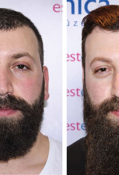 La planification préopératoire était parfaite. Mon chirurgien a corrigé l'asymétrie entre mes oreilles et les a rendues parfaitement proportionnées à mon visage. L'équipe de la clinique était merveilleuse, et grâce aux techniques modernes utilisées, il n'y a aucune cicatrice visible. Merci beaucoup.