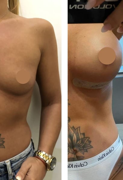 Das Team war sehr professionell. Sie haben mir geholfen, die perfekte Implantatgröße und -form auszuwählen, die perfekt zu meinen Körperproportionen passt.