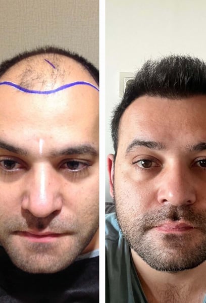 This is why I trusted them with my hair transplant in Istanbul.