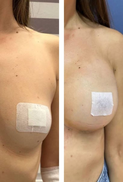 J'ai enfin trouvé le bon endroit pour ma chirurgie d'augmentation mammaire à Istanbul. Les résultats sont incroyablement naturels, exactement ce que j'espérais !