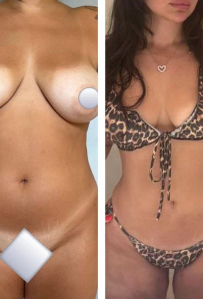 J'ai enfin le ventre plat dont j'ai rêvé pendant des années ! La liposuccion a éliminé cette graisse tenace au niveau du ventre que aucun entraînement ne pouvait toucher. Ma taille a l'air incroyable, et mes vêtements me vont comme un gant maintenant.