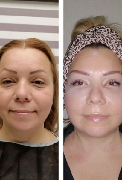 No importa cuánto durmiera, siempre parecía cansada. Después de mi lifting facial, esa apariencia pesada y agotada se ha ido. Finalmente luzco tan enérgica y vibrante como me siento por dentro.
