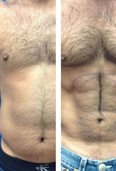 I used to feel self-conscious at the beach, but this procedure changed everything. My abdominal muscles were sculpted according to my natural anatomy, so it doesn't look 'fake' at all. It’s a total confidence booster, and I highly recommend this clinic to everyone.
