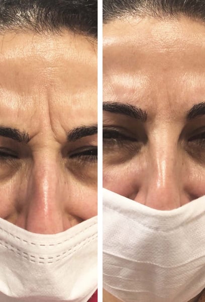 I was afraid of looking 'frozen,' but the results are perfect. My forehead lines are gone, yet I can still make expressions. I just look well-rested and refreshed!