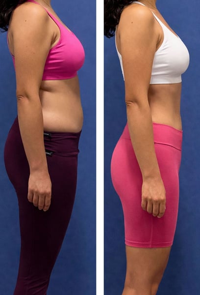 Най-много ми хареса в тази болница холистичният подход. Те не просто използваха устройствата; предоставиха ми хранителни съвети и следяха напредъка ми на всяка стъпка. Загубих 7 см около талията си само за два месеца. Персоналът е професионален и много окуражаващ.