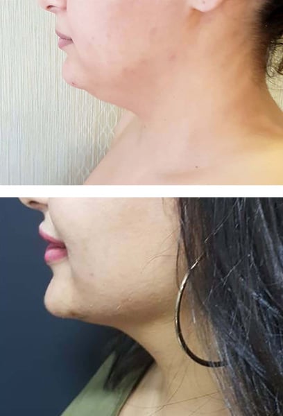 No matter how much weight I lost, I could never get rid of my double chin. After having submental liposuction at this clinic, my jawline is finally sharp and defined! It has completely changed the structure of my face, making me look much fitter and more athletic. I couldn't be happier with the results.