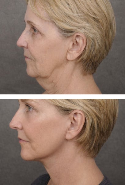 Submental Lipo was like an instant youth boost for me. The sagging under my chin made me look older and heavier than I actually was. Now that the excess fat is gone, my face looks lifted and refreshed. Everyone thinks I’ve lost weight, but I just found the right specialists!