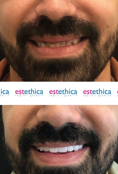 After researching everywhere, I chose them for my hair transplant in Istanbul