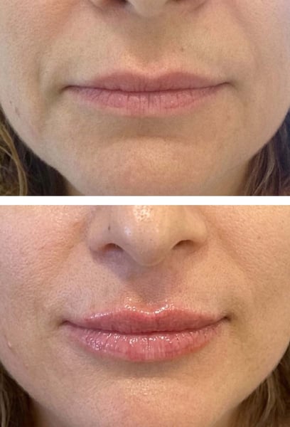 As I got older, my lips started losing their volume and developed fine lines. The filler didn't just add volume; it made my lips look youthful and smooth again. They feel soft and look incredibly healthy. I'm obsessed!