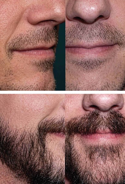I was worried it wouldn't look natural, but the result is incredible. The transition from my cheeks to my beard is seamless. My barber even asked where I got it done!