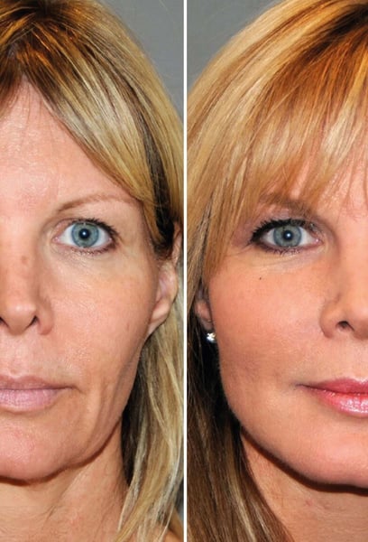 A facelift was the best gift I could give myself. It’s not just about wrinkles; it’s about how it makes you feel when you wake up every morning. I feel beautiful again.